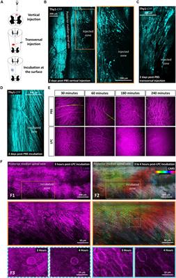 Longitudinal Intravital Microscopy Reveals Axon Degeneration Concomitant With Inflammatory Cell Infiltration in an LPC Model of Demyelination